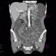 Ileocecal resection, Crohn's disease, CT enterography: CT - Computed tomography